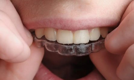 Sognare di raddrizzare i denti : 16 scenari e interpretazioni