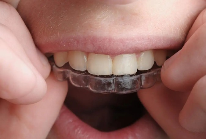  Sognare di raddrizzare i denti : 16 scenari e interpretazioni