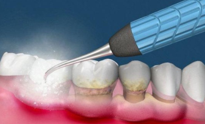 Sognare di farsi pulire i denti : 12 scenari e interpretazioni
