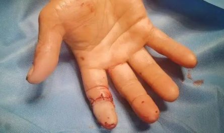 Sognare di dita rotte : 24 scenari e interpretazioni