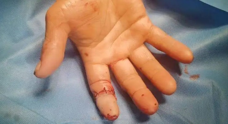 Sognare di dita rotte : 24 scenari e interpretazioni