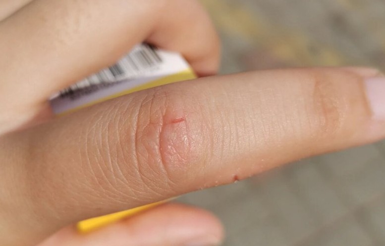 Sognare un infortunio al dito : 28 scenari e interpretazioni