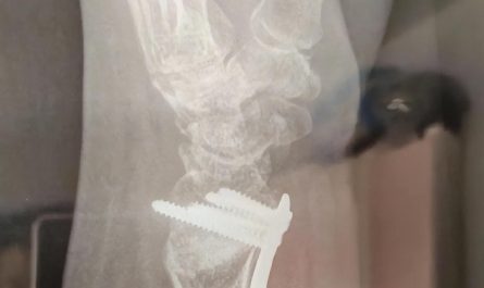 Sognare di un polso rotto : 16 scenari e interpretazioni